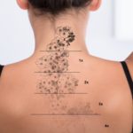 Laser Tattoo Removal Technician [PTIB Approved Certificate Program]