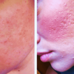 acne peel