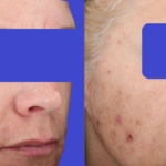 CHEMICAL PEELS FOR AGE SPOTS